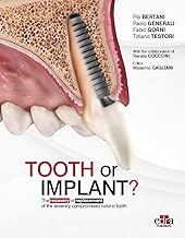 Tooth or Implant? The recovery or replacement of the severely compormised natural tooth