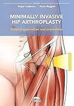 Minimally invasive hip arthroplasty. Surgical approaches and procedures